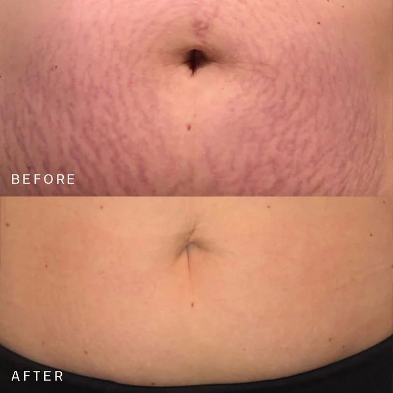 Mud + Tallow - Belly Skin Renewal Duo